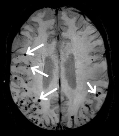 амилоидная ангиопатия